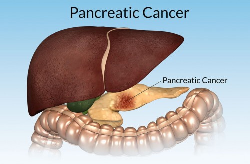 Pancreatic-Cancer-100-1024x67212c0a0dda5e9f9d8.jpg